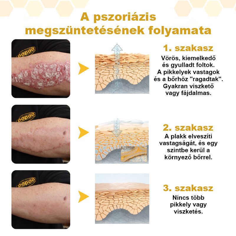 🐝 Auralithe® PsoriaSoothe – Szteroidmentes méhméreges krém viszkető, hámló és érzékeny bőrre ⭐⭐