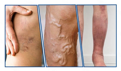 🇭🇺𝐇𝐞𝐚𝐥𝐫𝐢𝐳𝐞® 👩‍⚕️👩‍⚕️VeinTarget mikrotűs tapasz⚡☑️Azonnali enyhülés hosszú távú eredmények