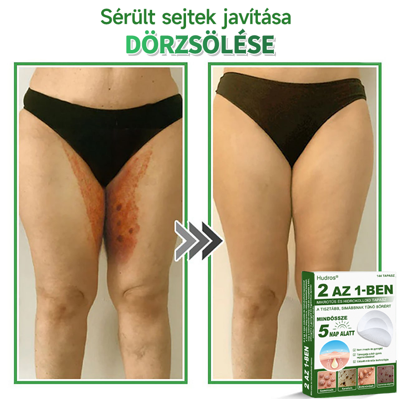 🍀 Hudros® 2 az 1-ben mikrotűs tapasz – célzott segítség szemölcsök, bőrkinövések, pattanások és sötét foltok ellen | 144 db-os csomag-0615-nk5