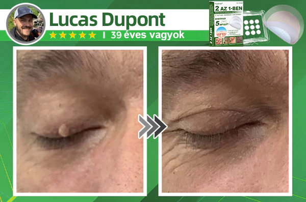 👉Hudros® 😜 2-az-1-ben Mikrotű & Hidrokoloid Tapasz | Kiemelkedő Anyajegyek, Pattanások, Lapos Szemölcsök & Bőrkinövések Eltávolítója | Ráncok, Hegek & Bőrhibák Javítása | Láthatatlan Csillag Pattanástapasz Arcra & Testre | 144 db