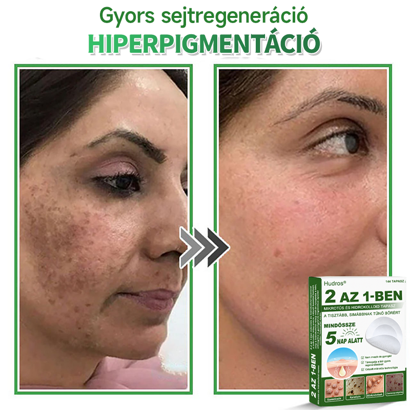 🍀 Hudros® 2 az 1-ben mikrotűs tapasz – célzott segítség szemölcsök, bőrkinövések, pattanások és sötét foltok ellen | 144 db-os csomag-0615-nk5