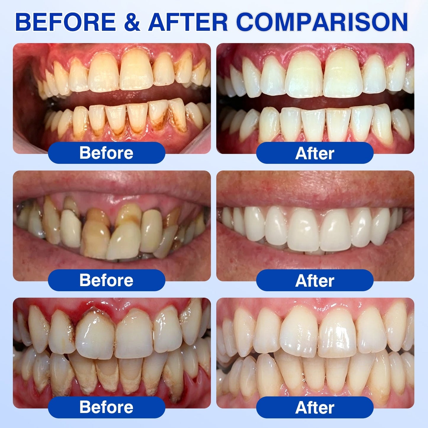 👨‍⚕️🦷✨Evolvion® GumRevive fogágyregeneráló gél