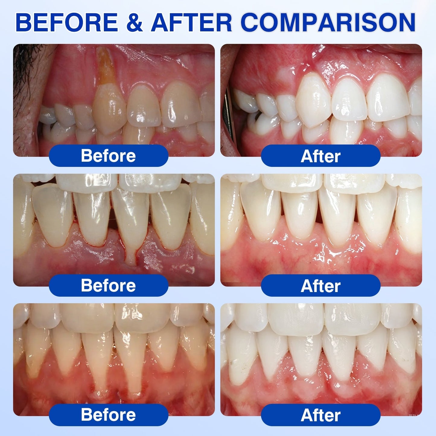 👨‍⚕️🦷✨Evolvion® GumRevive fogágyregeneráló gél