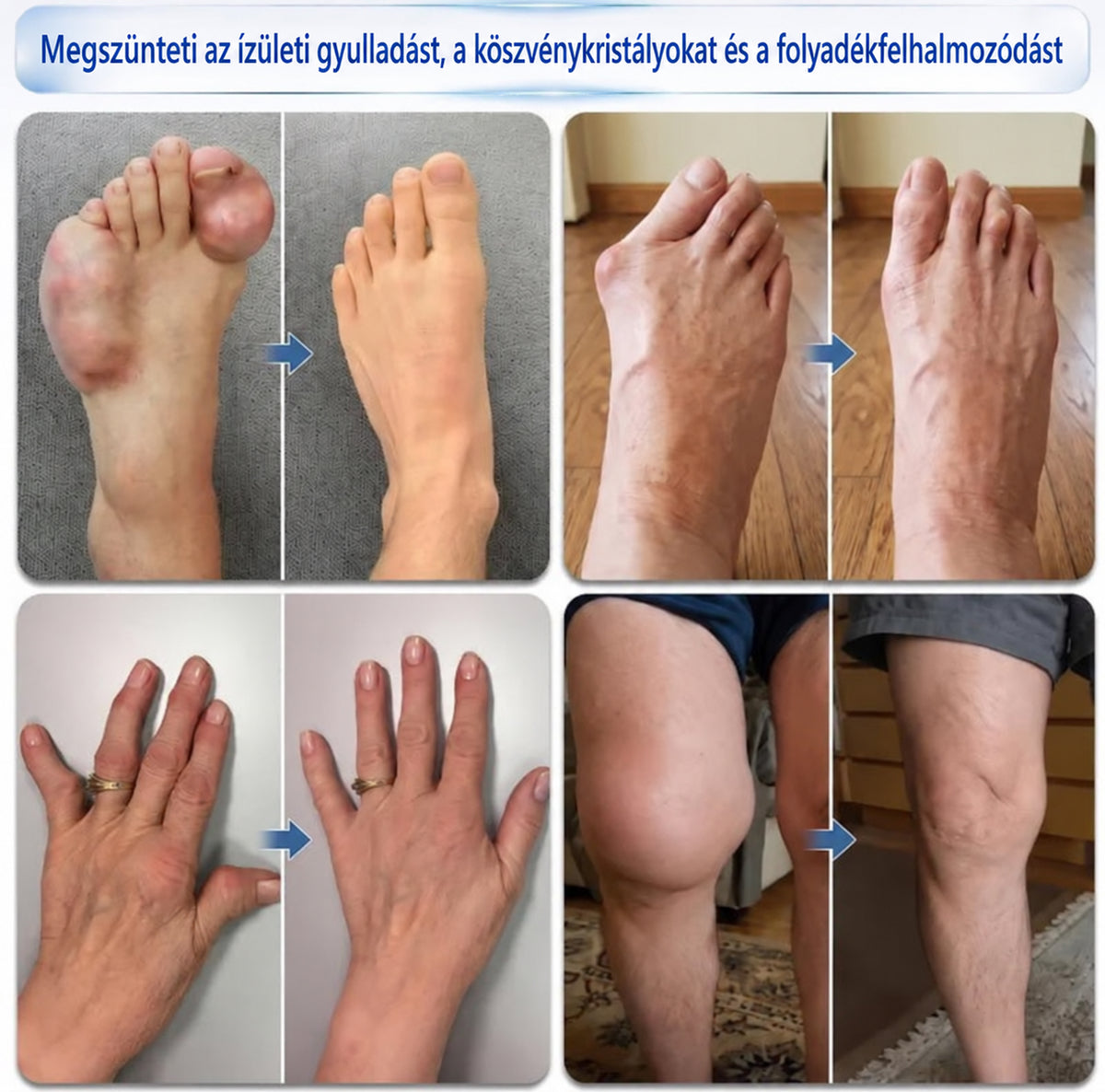 🦵 CleraNaure® Gyors Hatású Ízület- és Csonttámogató Formula ✨ Mikrotűs Ízület- és Csontregeneráló Görgő⭐️