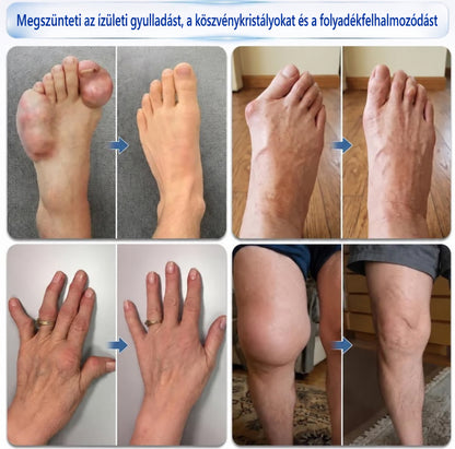 🦵 CleraNaure® Gyors Hatású Ízület- és Csonttámogató Formula ✨ Mikrotűs Ízület- és Csontregeneráló Görgő⭐️