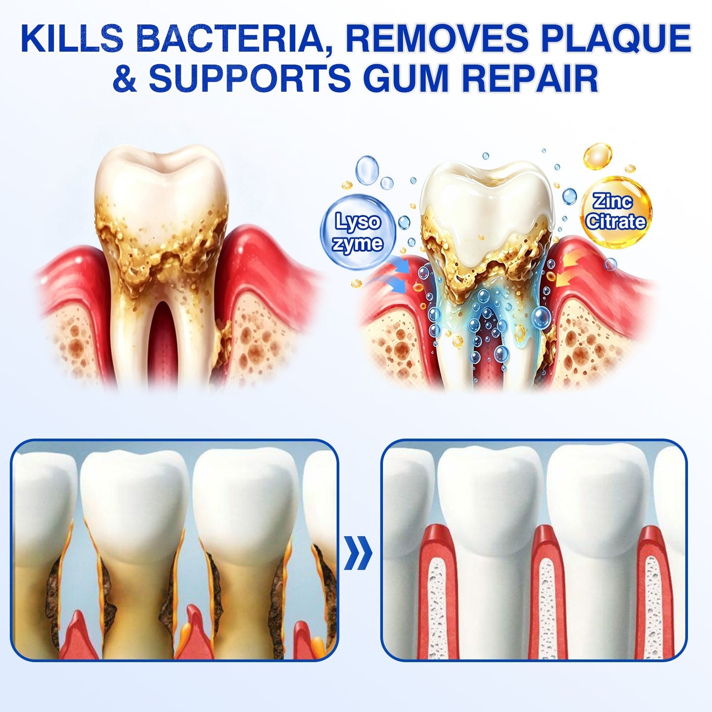👨‍⚕️🦷✨Evolvion® GumRevive fogágyregeneráló gél
