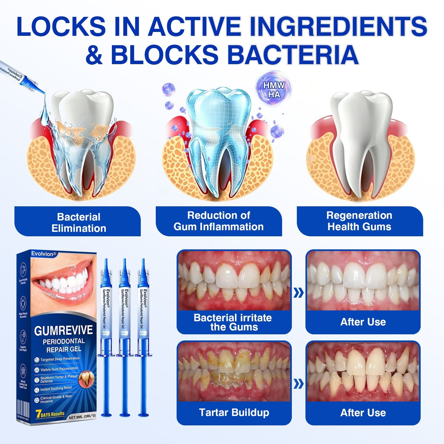 👨‍⚕️🦷✨Evolvion® GumRevive fogágyregeneráló gél