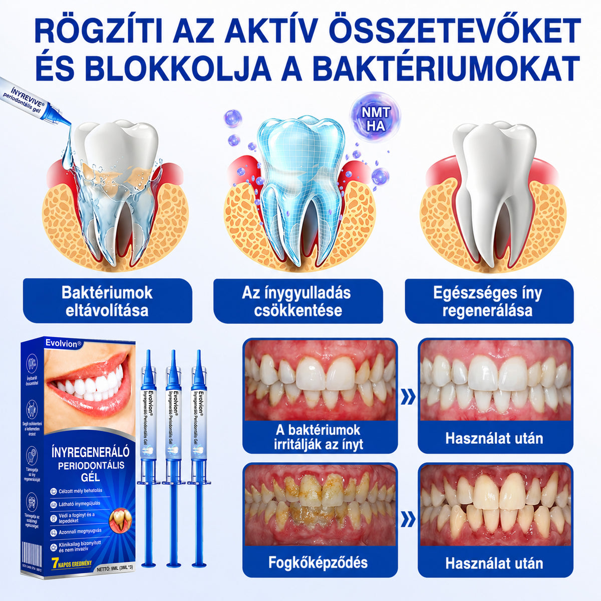 👨‍⚕️🦷✨Evolvion® GumRevive fogágyregeneráló gél