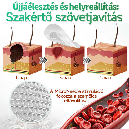 🍀 Hudros® 2 az 1-ben mikrotűs tapasz – célzott segítség szemölcsök, bőrkinövések, pattanások és sötét foltok ellen | 144 db-os csomag-0615-nk5