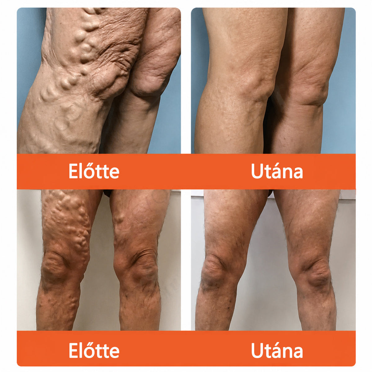🔥 Zvoevo® Vein Ease mikro-tűs ápoló tapasz (pókgerincvénák, visszér, duzzanat, fáradt lábak kezelésére)