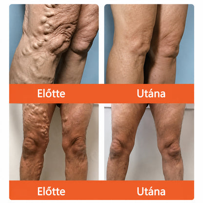 🌈 Zvoevo® Vein Ease mikro-tűs ápoló tapasz (pókgerincvénák, visszér, duzzanat, fáradt lábak kezelésére)