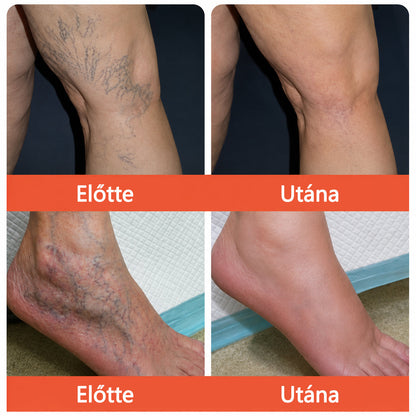🌈 Zvoevo® Vein Ease mikro-tűs ápoló tapasz (pókgerincvénák, visszér, duzzanat, fáradt lábak kezelésére)