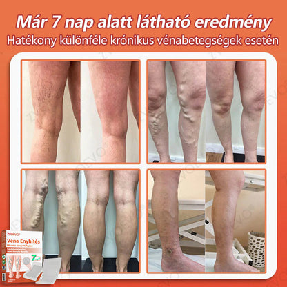 🌈 Zvoevo® Vein Ease mikro-tűs ápoló tapasz (pókgerincvénák, visszér, duzzanat, fáradt lábak kezelésére)