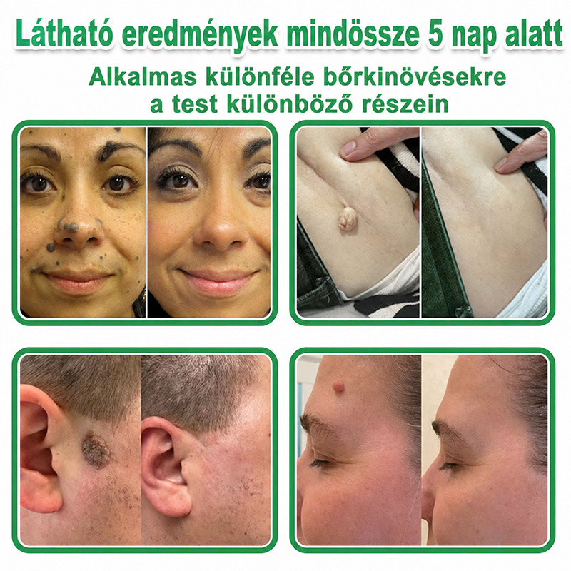 👉Hudros® 😜 2-az-1-ben Mikrotű & Hidrokoloid Tapasz | Kiemelkedő Anyajegyek, Pattanások, Lapos Szemölcsök & Bőrkinövések Eltávolítója | Ráncok, Hegek & Bőrhibák Javítása | Láthatatlan Csillag Pattanástapasz Arcra & Testre | 144 db