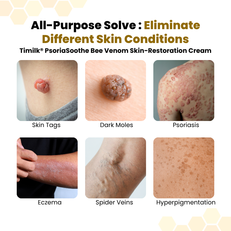 Timilk® PsoriaSoothe Bee Venom Skin-Restoration Cream