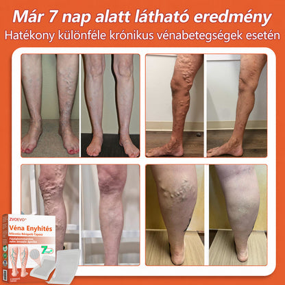 🌈 Zvoevo® Vein Ease mikro-tűs ápoló tapasz (pókgerincvénák, visszér, duzzanat, fáradt lábak kezelésére)