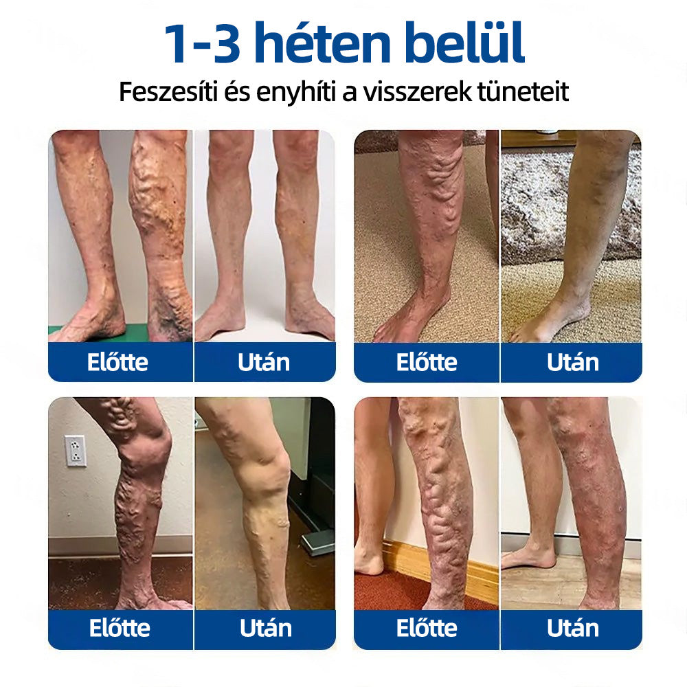 🇭🇺𝐇𝐞𝐚𝐥𝐫𝐢𝐳𝐞® 👩‍⚕️👩‍⚕️VeinTarget mikrotűs tapasz⚡☑️Azonnali enyhülés hosszú távú eredmények