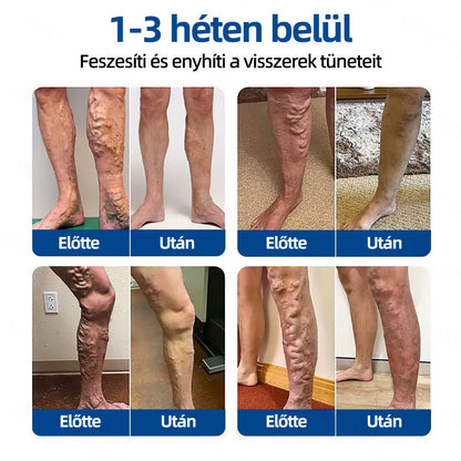 🇭🇺𝐇𝐞𝐚𝐥𝐫𝐢𝐳𝐞® 👩‍⚕️👩‍⚕️VeinTarget mikrotűs tapasz⚡☑️Azonnali enyhülés hosszú távú eredmények