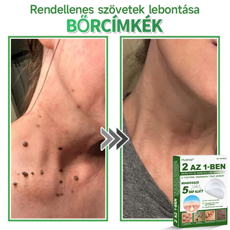 👉Hudros® 😜 2-az-1-ben Mikrotű & Hidrokoloid Tapasz | Kiemelkedő Anyajegyek, Pattanások, Lapos Szemölcsök & Bőrkinövések Eltávolítója | Ráncok, Hegek & Bőrhibák Javítása | Láthatatlan Csillag Pattanástapasz Arcra & Testre | 144 db