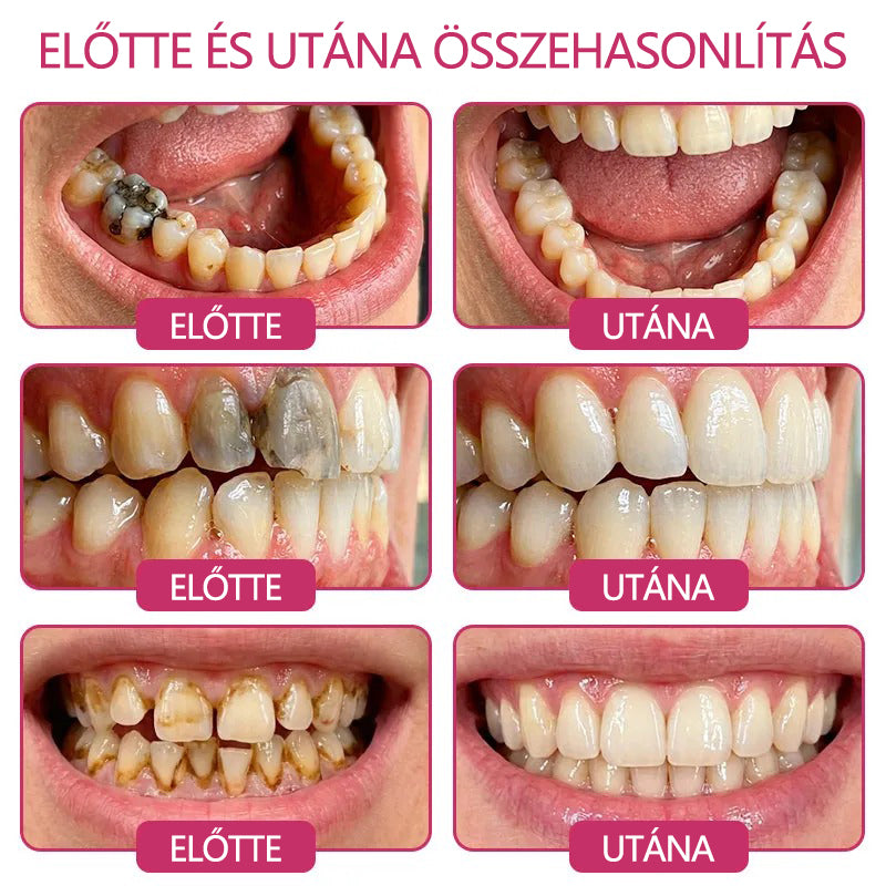 CleraNaure® DenPerm Fogzománc-helyreállító Töltőgél🎁