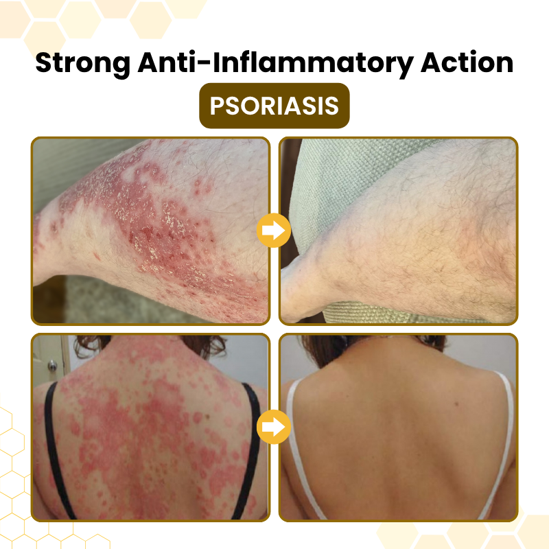 Timilk® PsoriaSoothe Bee Venom Skin-Restoration Cream