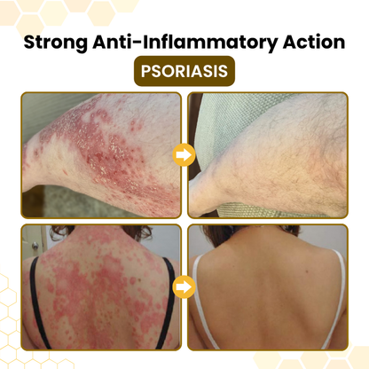 Timilk® PsoriaSoothe Bee Venom Skin-Restoration Cream