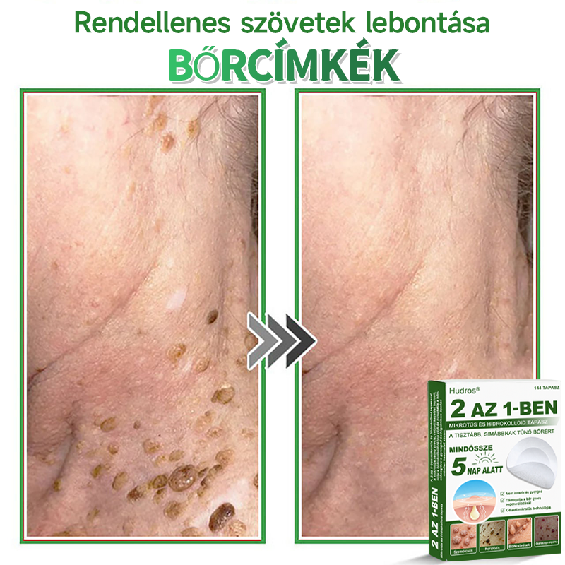 👉Hudros® 😜 2-az-1-ben Mikrotű & Hidrokoloid Tapasz | Kiemelkedő Anyajegyek, Pattanások, Lapos Szemölcsök & Bőrkinövések Eltávolítója | Ráncok, Hegek & Bőrhibák Javítása | Láthatatlan Csillag Pattanástapasz Arcra & Testre | 144 db