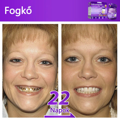 𝐷𝑜𝒓𝒎𝒐𝒓𝑛𝑎® Fogregeneráló és -javító por hidroxiapatittal 🦷 (hatékonyan javítja a fogszuvasodást, az ínyproblémákat, a fogak túlérzékenységét, a szájfekélyeket és a fogak sárgulását, átfogóan javítva a szájhigiéniát) 🍀
