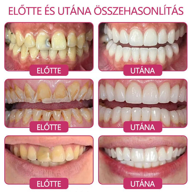 CleraNaure® DenPerm Fogzománc-helyreállító Töltőgél🎁
