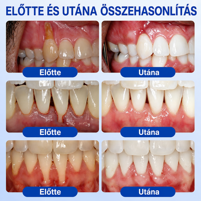 👨‍⚕️🦷✨Evolvion® GumRevive fogágyregeneráló gél