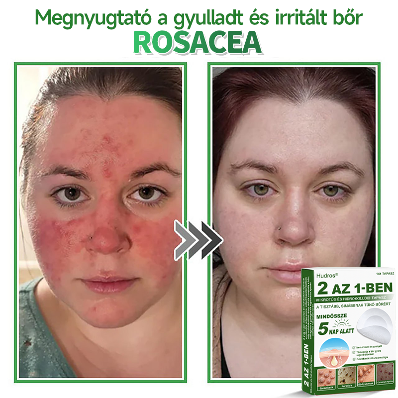 👉Hudros® 😜 2-az-1-ben Mikrotű & Hidrokoloid Tapasz | Kiemelkedő Anyajegyek, Pattanások, Lapos Szemölcsök & Bőrkinövések Eltávolítója | Ráncok, Hegek & Bőrhibák Javítása | Láthatatlan Csillag Pattanástapasz Arcra & Testre | 144 db