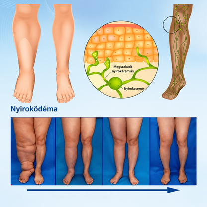 Hivatalos Bolt: Timilk® LymphoEase Magnézium-PCA Roll-On Nyugtató Krém 🔥 FDA-tanúsítvánnyal rendelkezik (Klinikailag igazolt hatékonyság nyiroködéma, lábdagadás és rossz keringés ellen 🩺)