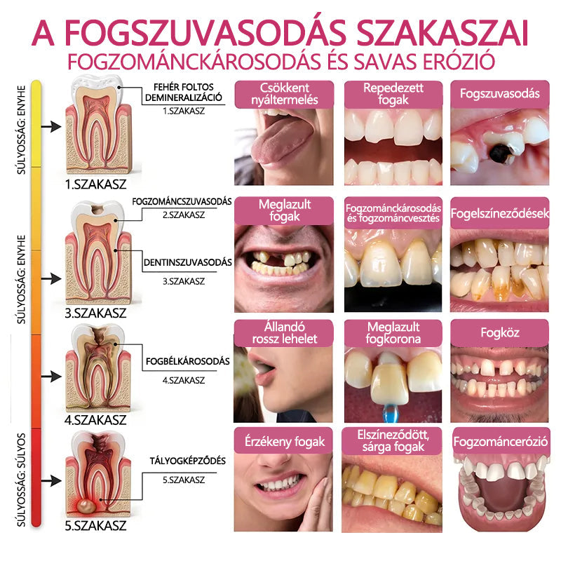 CleraNaure® DenPerm Fogzománc-helyreállító Töltőgél🎁