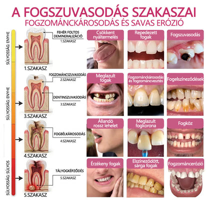 CleraNaure® DenPerm Fogzománc-helyreállító Töltőgél🎁