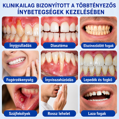 👨‍⚕️🦷✨Evolvion® GumRevive fogágyregeneráló gél