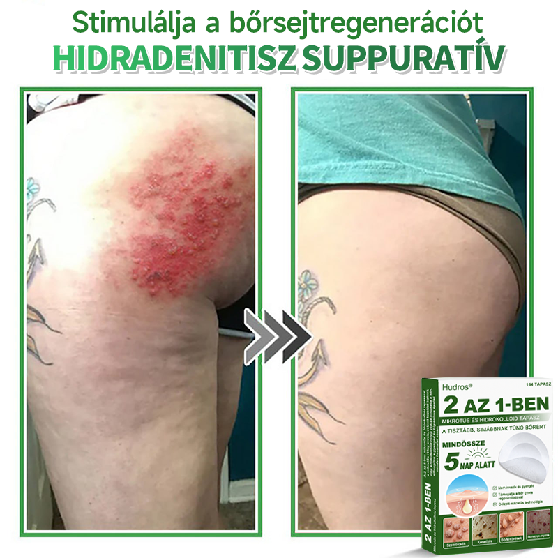 👉Hudros® 😜 2-az-1-ben Mikrotű & Hidrokoloid Tapasz | Kiemelkedő Anyajegyek, Pattanások, Lapos Szemölcsök & Bőrkinövések Eltávolítója | Ráncok, Hegek & Bőrhibák Javítása | Láthatatlan Csillag Pattanástapasz Arcra & Testre | 144 db