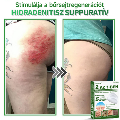 👉Hudros® 😜 2-az-1-ben Mikrotű & Hidrokoloid Tapasz | Kiemelkedő Anyajegyek, Pattanások, Lapos Szemölcsök & Bőrkinövések Eltávolítója | Ráncok, Hegek & Bőrhibák Javítása | Láthatatlan Csillag Pattanástapasz Arcra & Testre | 144 db