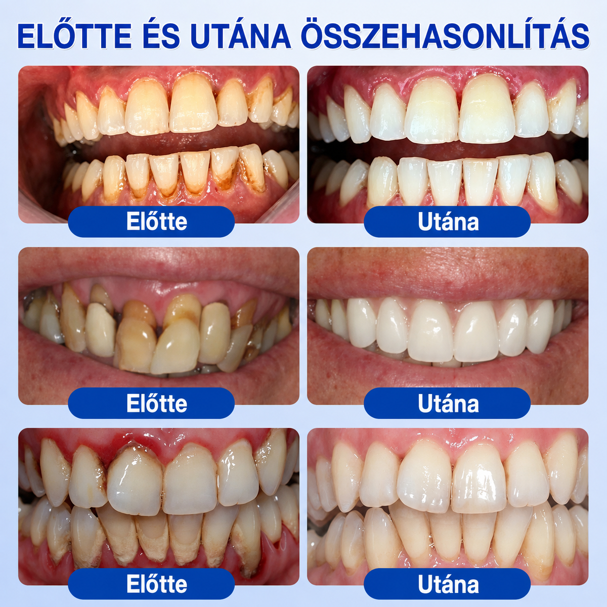 👨‍⚕️🦷✨Evolvion® GumRevive fogágyregeneráló gél