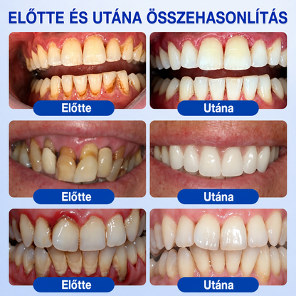 👨‍⚕️🦷✨Evolvion® GumRevive fogágyregeneráló gél