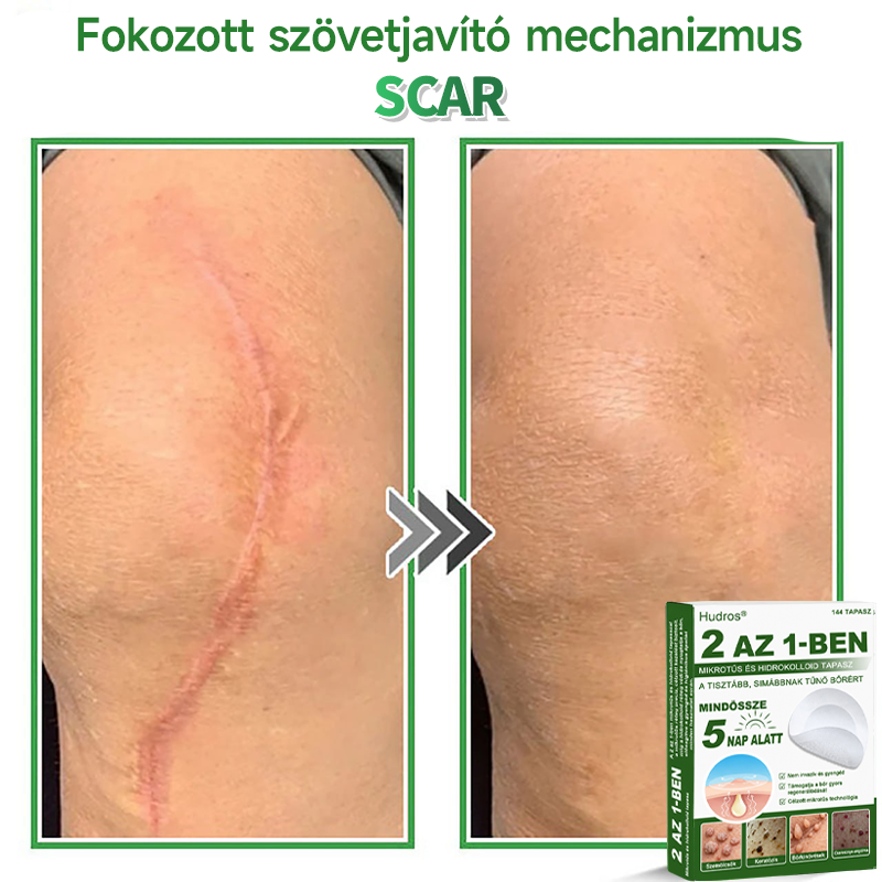 🍀 Hudros® 2 az 1-ben mikrotűs tapasz – célzott segítség szemölcsök, bőrkinövések, pattanások és sötét foltok ellen | 144 db-os csomag-0615-nk5