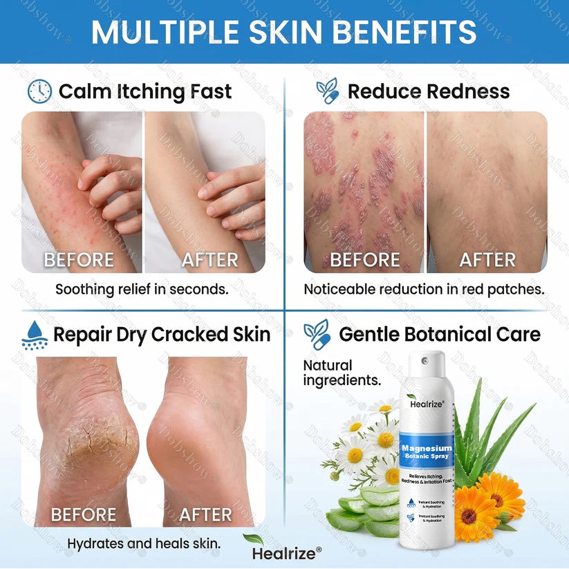 🔥Healrize® Magnesium Botanic Spray – Advanced Skin Recovery for Psoriasis & Eczema | Rapid Soothing, Steroid-Free