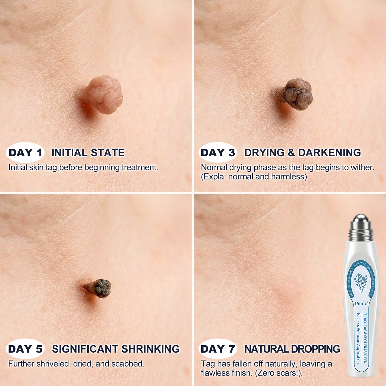 𝐏i𝐜𝐝o® 7-𝐷𝑎𝑦 𝗧𝐚𝐠 & 𝗦𝗽𝐨𝐭 𝐄𝐫𝒂𝒔𝒆𝒓✅💎(Zero Pain, Zero 𝐒𝐜𝐚𝒓𝒔 Rollerball)
