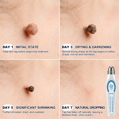 𝐏i𝐜𝐝o® 7-𝐷𝑎𝑦 𝗧𝐚𝐠 & 𝗦𝗽𝐨𝐭 𝐄𝐫𝒂𝒔𝒆𝒓✅💎(Zero Pain, Zero 𝐒𝐜𝐚𝒓𝒔 Rollerball)